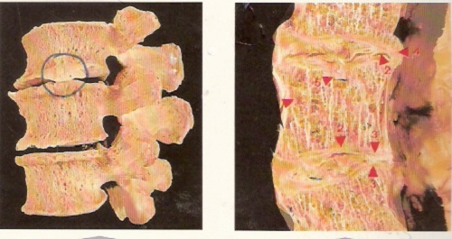 bệnh gai đôi cột sống