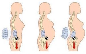 Nguyên nhân làm cho phụ nữ mang thai bị đau lưng