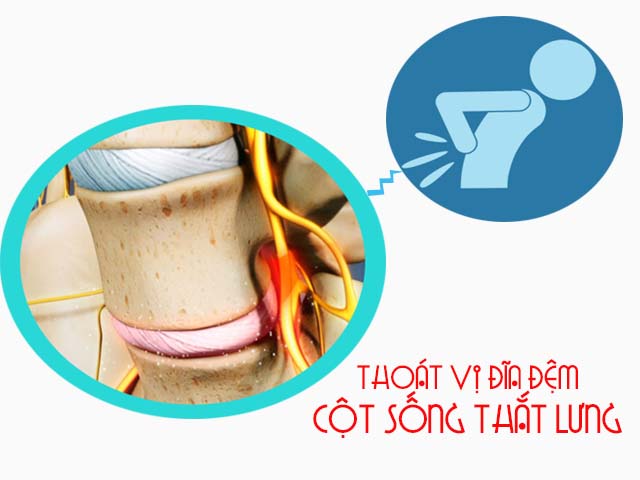 Bệnh thoát vị đĩa đệm cột sống thắt lưng