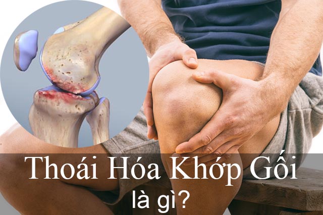 Chữa Bệnh Thoái Hóa Khớp Gối - [Có rất nhiều cách]