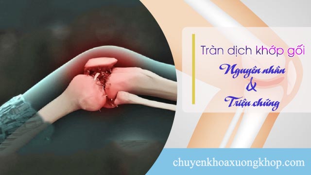 Tràn dịch khớp gối