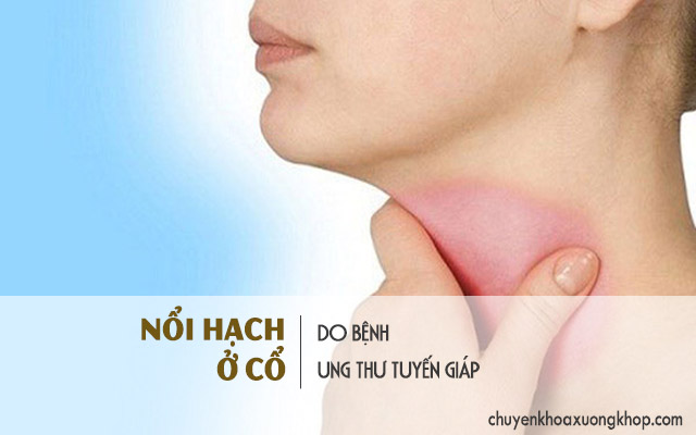 Nổi hạch ở cổ do ung thư tuyến giáp