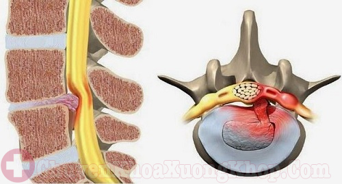 Thoái hóa cột sống thắt lưng gây thoát vị đĩa đệm