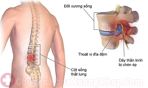 Chèn ép các dây thần kinh do thoái hóa cột sống thắt lưng