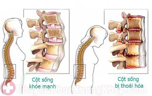 Thoái hóa cột sống thắt lưng