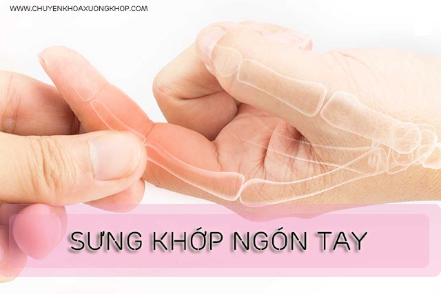 sưng đau khớp ngón tay 