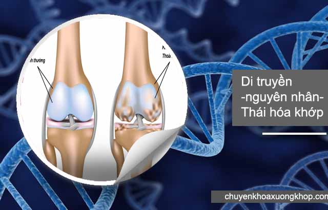 di truyền là nguyên nhân thoái hóa khớp gối