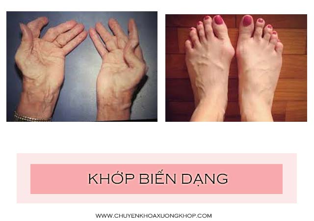 biến dạng khớp là triệu chứng nặng của viêm khớp