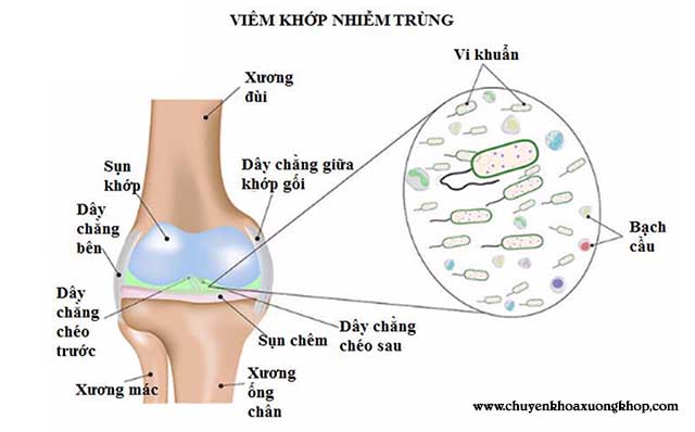 viêm khớp nhiễm trùng gây sưng đau khớp ngón tay