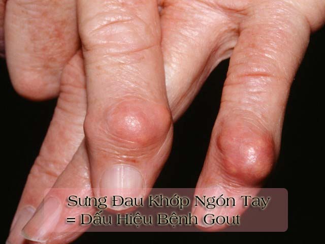 bệnh gout làm sưng đau khớp ngón tay