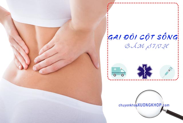 Gai đôi cột sống bẩm sinh