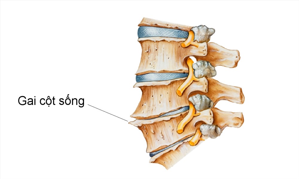 Gai cột sống cổ là bệnh phải trị từ gốc