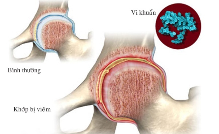 Viêm khớp nhiễm khuẩn là bệnh lý nguy hiểm cần xử lý kịp thời