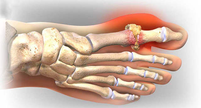 bệnh gút giai đoạn cuối