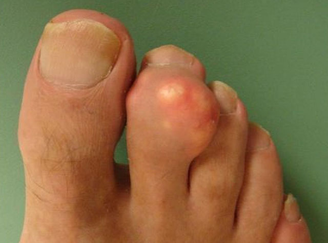 biến chứng của bệnh Gout
