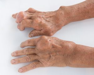 bệnh Gout lây qua những con đường nào