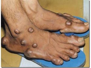 triệu chứng bệnh gout mãn tính 