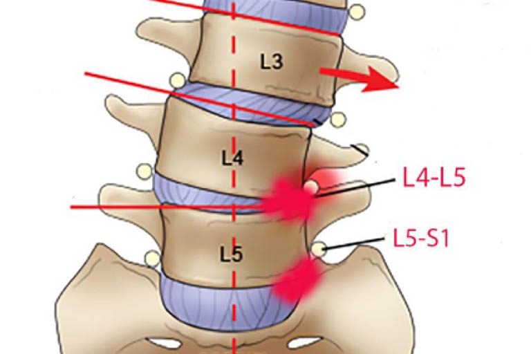 Thoát vị đĩa đệm L4 L5 nằm vị trí thấp nhất và thường chịu áp lực lên toàn bộ phần trên của cơ thể